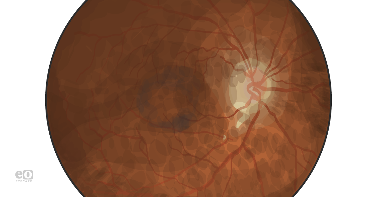 Ophthalmology Case Study: Pentosan Maculopathy Mimicking Pattern Dystrophy