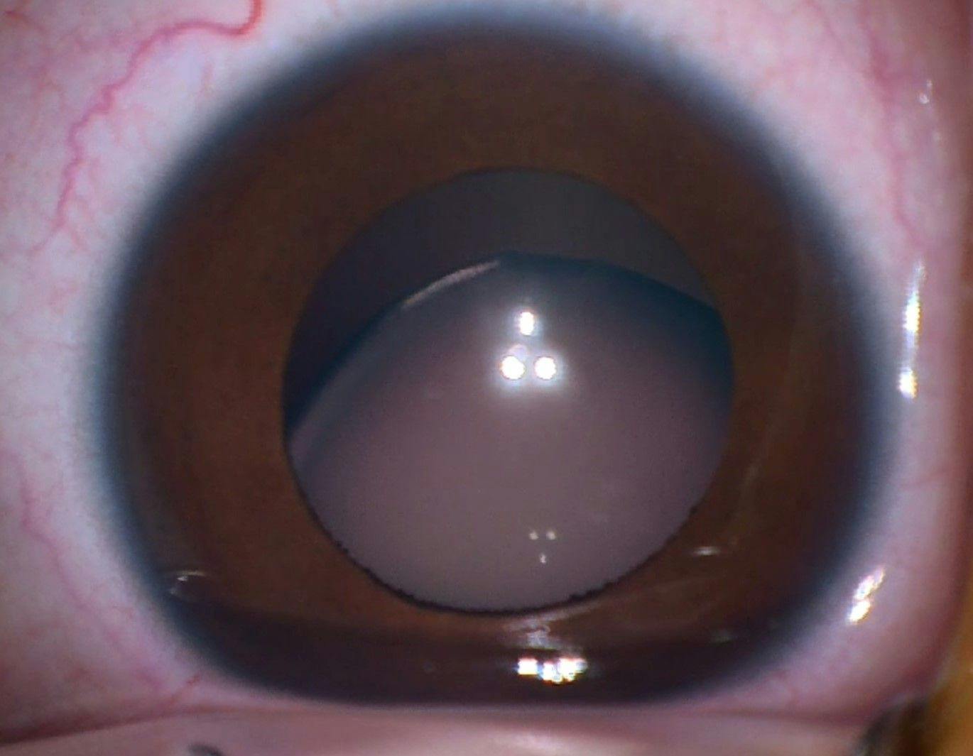 Marfan syndrome cataract