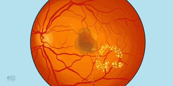 Pseudophakic Cystoid Macular Edema: What to Do and When to Refer