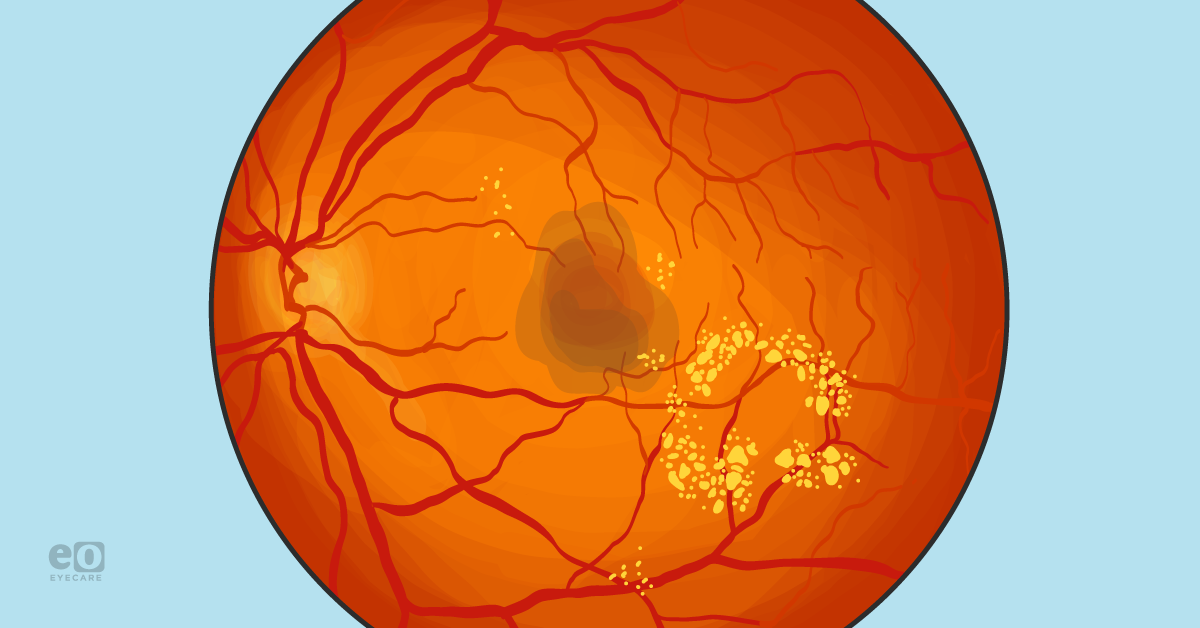 Pseudophakic Cystoid Macular Edema: What to Do and When to Refer