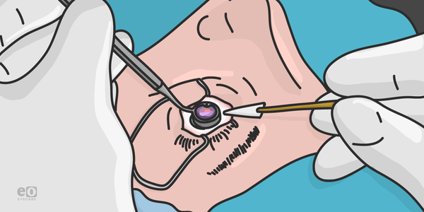 The Ultimate Guide to Glaucoma Surgery