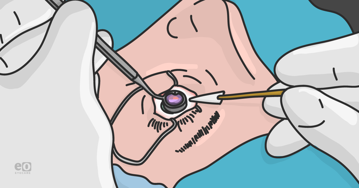 The Ultimate Guide to Glaucoma Surgery