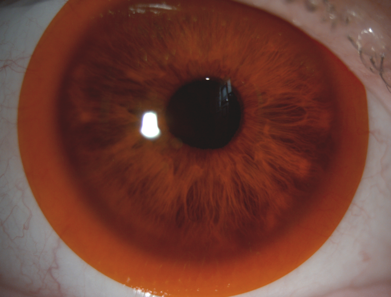 Amber-tinted Contact Lens
