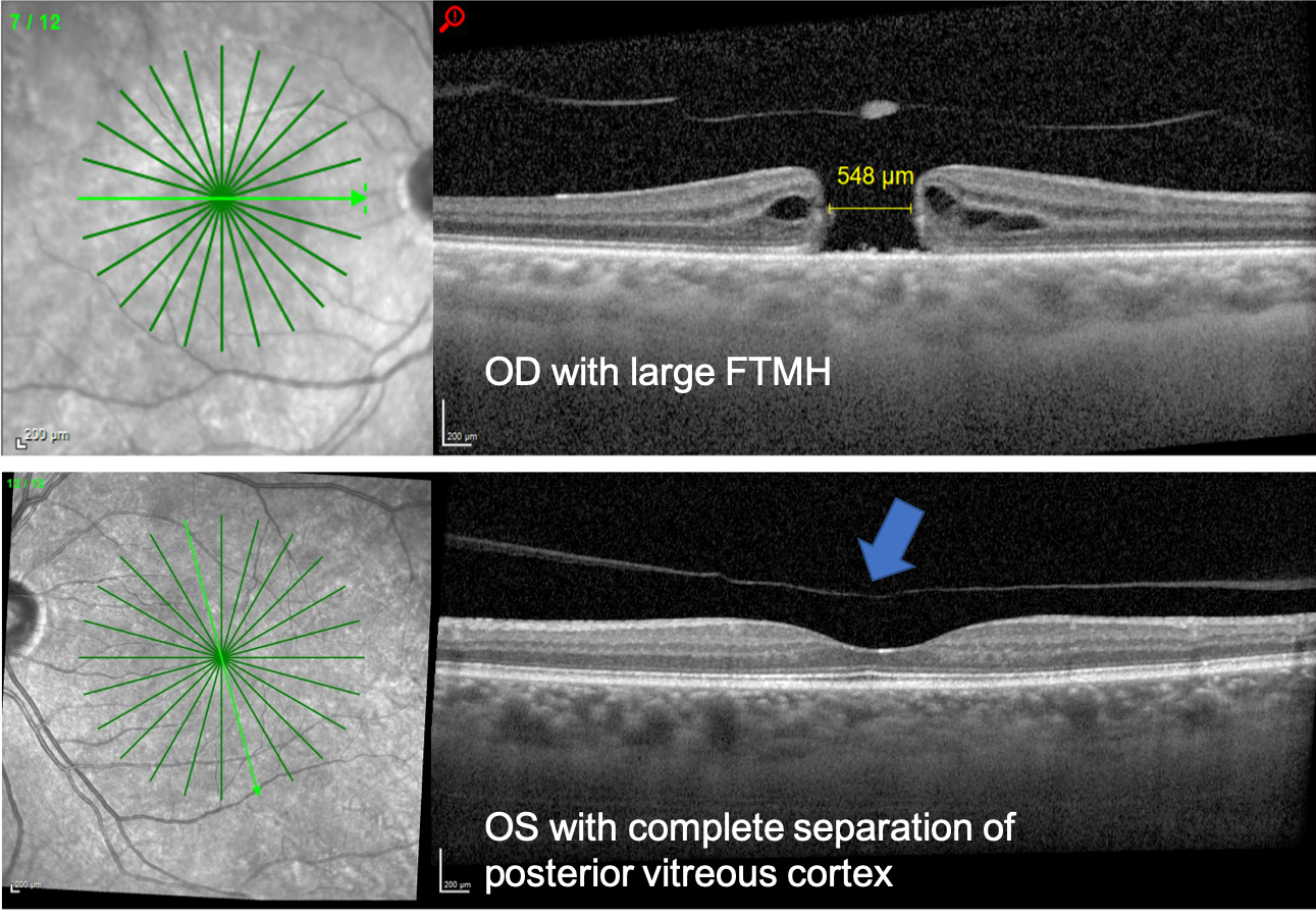 Full-Thickness Macular Hole