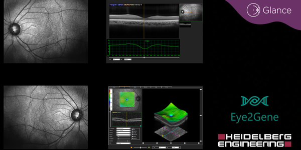Heidelberg and Eye2Gene partner on AI ophthalmic diagnostics for IRD