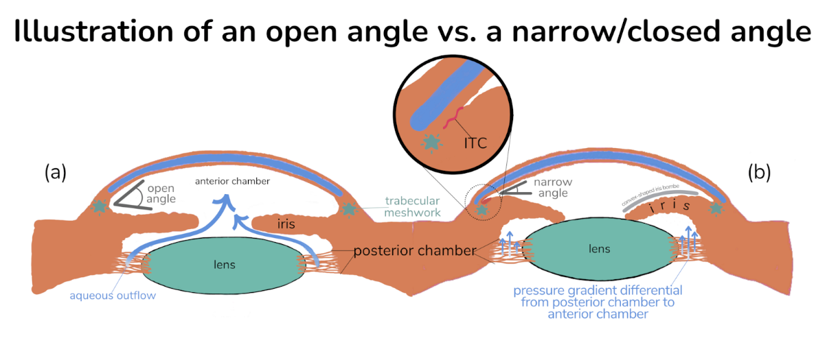Diagram of open vs narrow/closed angle