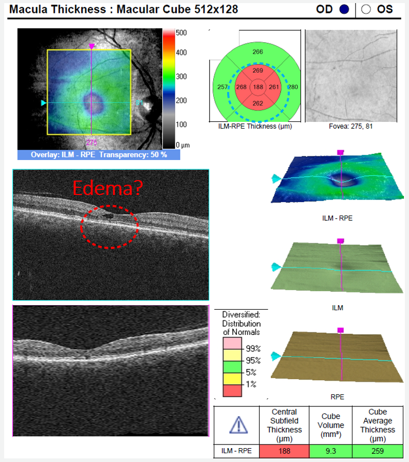 Note the central retinal thinning on the topographic and thickness maps of this macular cube OCT.  This thinning is due to atrophy of the retina indicating MacTel
