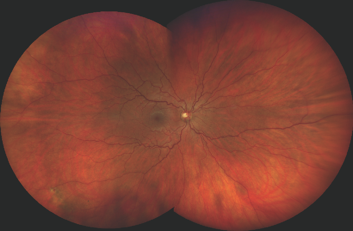 Figure 1: With 2 automontaged images the CLARUS spans a total of 200 degrees allowing for a much greater field of view into the outer peripheral areas of the retina.