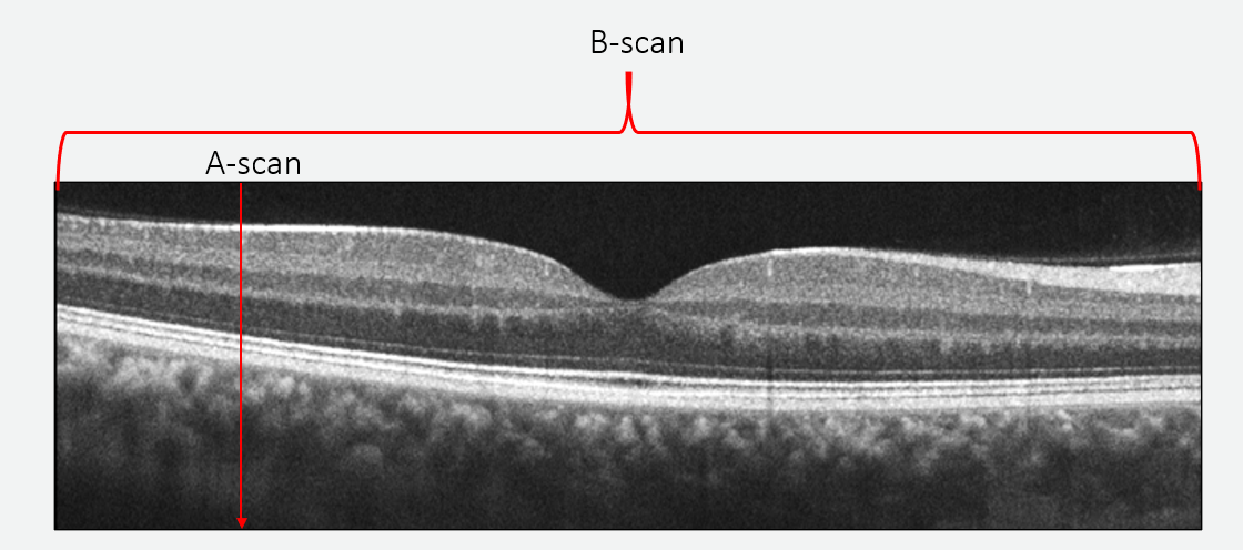 A B-scan is made up of many adjacent A-scans to create a “slice” of the retina