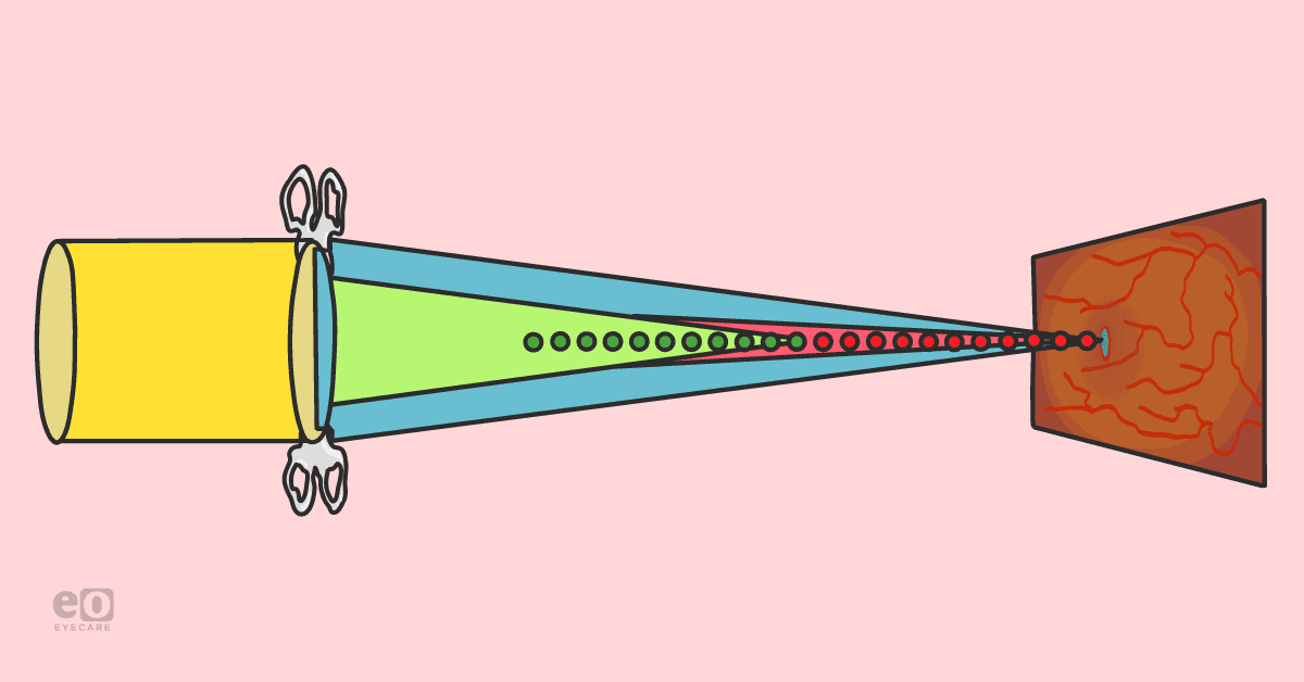 Extended Depth-of-Field Lenses: A Game-Changing IOL