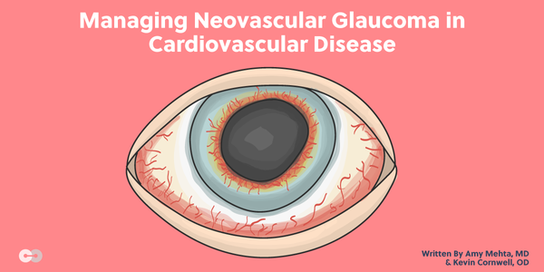 Managing Neovascular Glaucoma in Cardiovascular Disease
