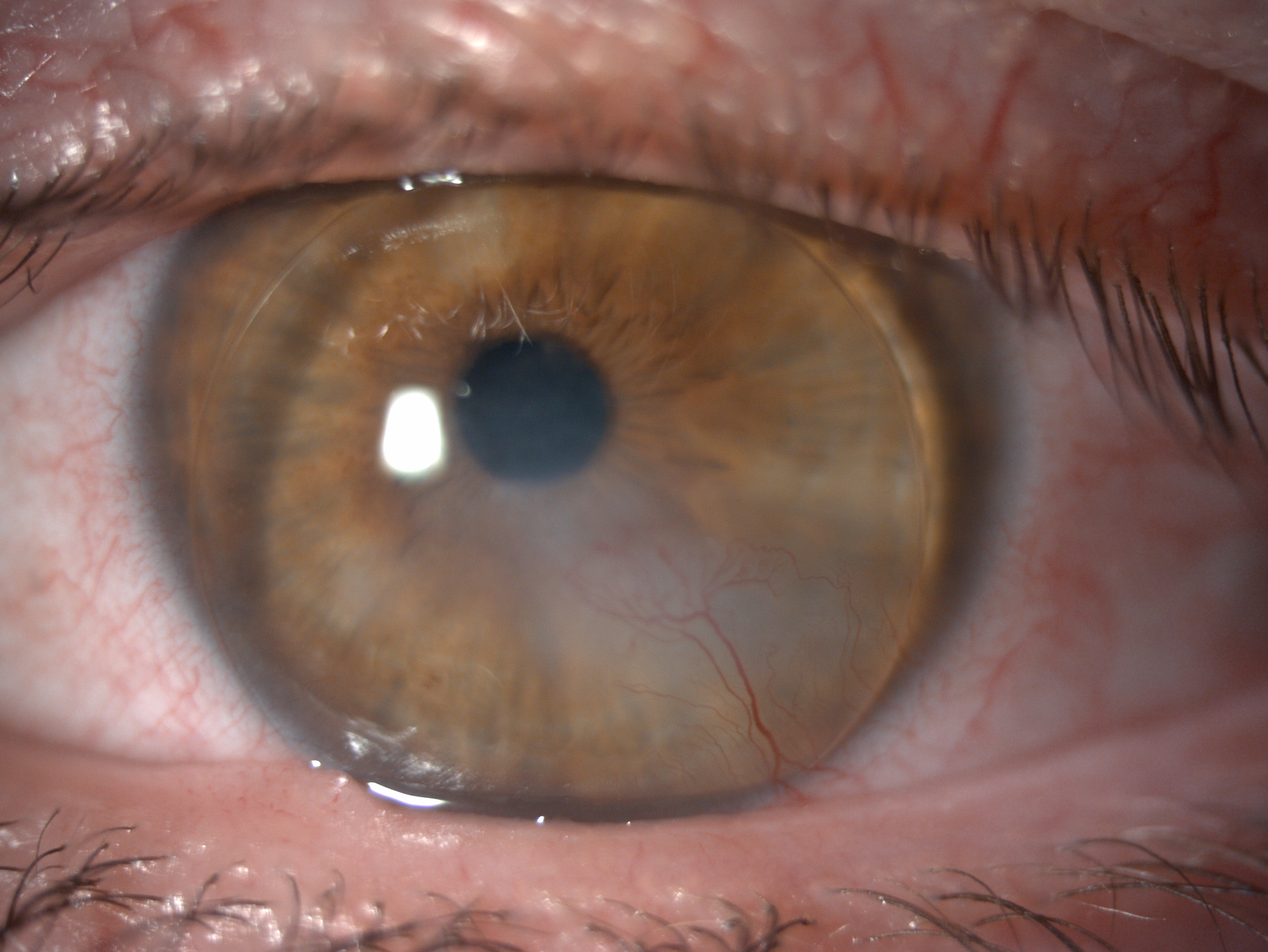 GP Lens on Eye with Corneal Scarring and Neovascularization