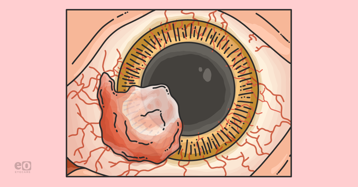 Diagnosis and Treatment of Ocular Surface Neoplasms