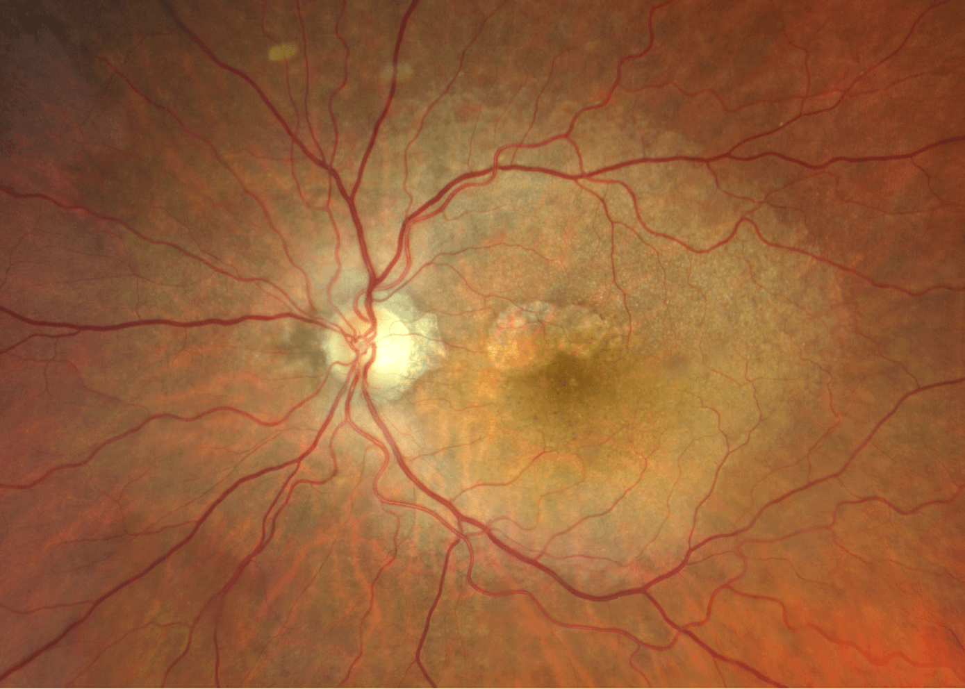 Ga Oct Tracking Geographic Atrophy: Clinical Biomarkers and Imaging Insights