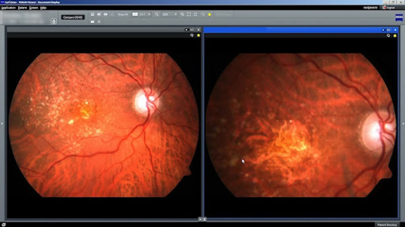 Fundus photography shows geographic atrophy