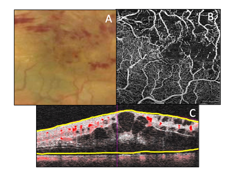 Fundus photography (A), OCTA map of the deep capillary plexus (B), and structural blood flow analysis B scan (C) representing macular ischemia
