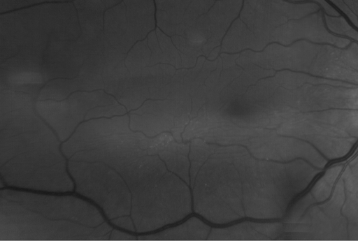 Figure 14: Epiretinal membrane being viewed with a red-free filter.