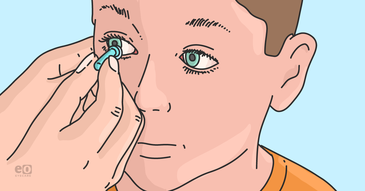 How to Successfully Fit Children with Contact Lenses