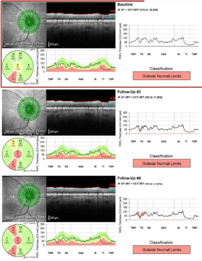 Topical Therapies for the Glaucoma Patient