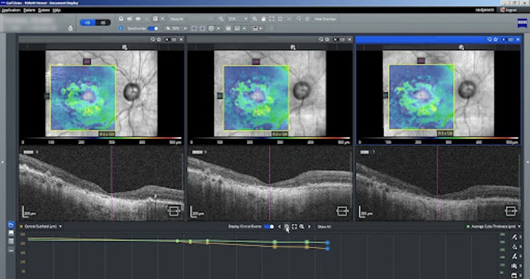 Macular Thickness Analysis in ZEISS FORUM