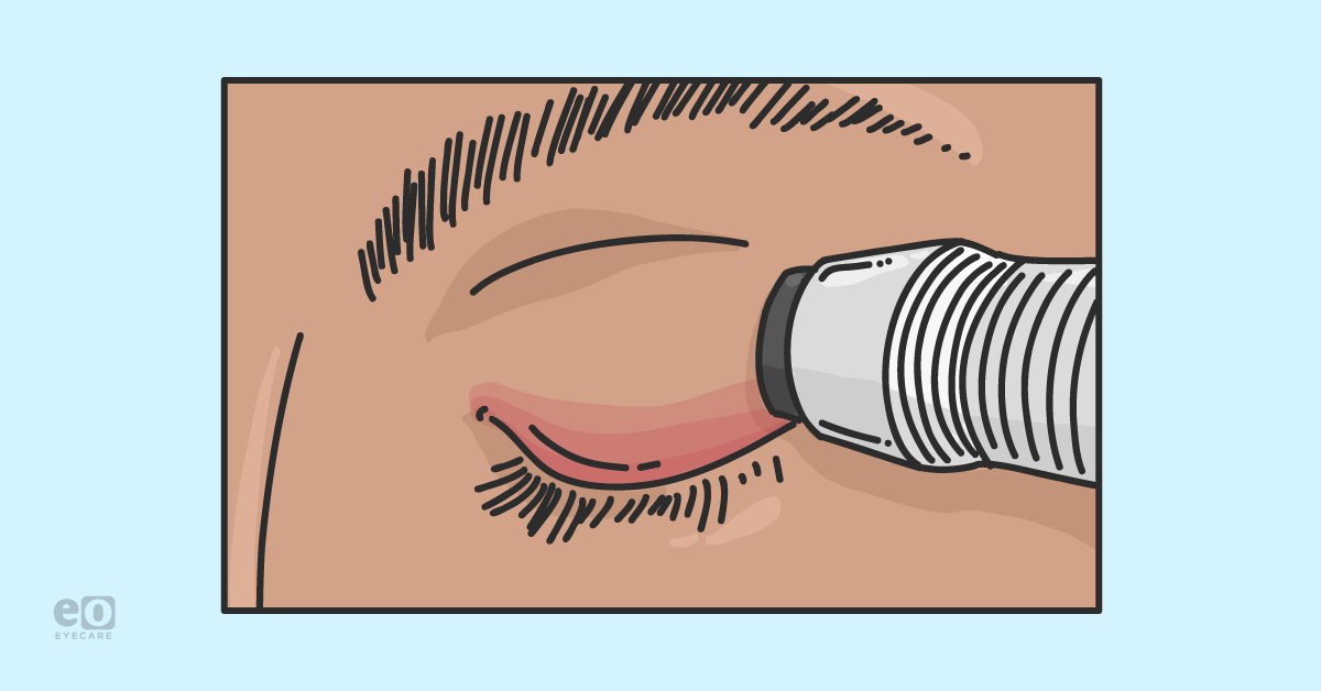 How Radiofrequency Can Be Used to Treat Dry Eyes