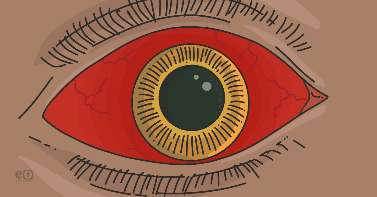 Closeup of a patient with a retrobulbar hemorrhage, a potential complication of oculoplastic and/or orbital surgery.