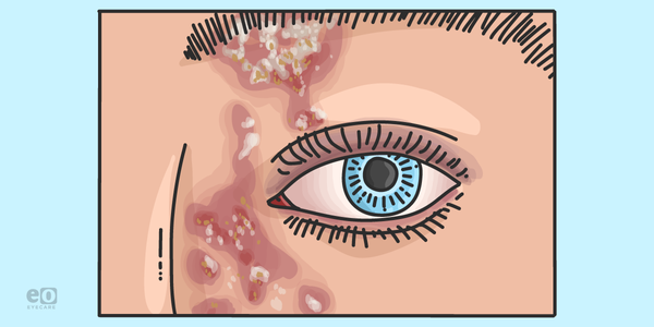 Ocular Manifestations and Management of Herpes Zoster