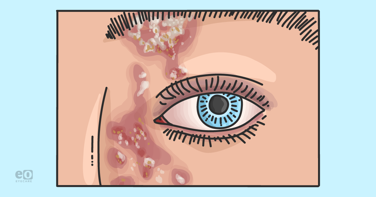 Ocular Manifestations and Management of Herpes Zoster