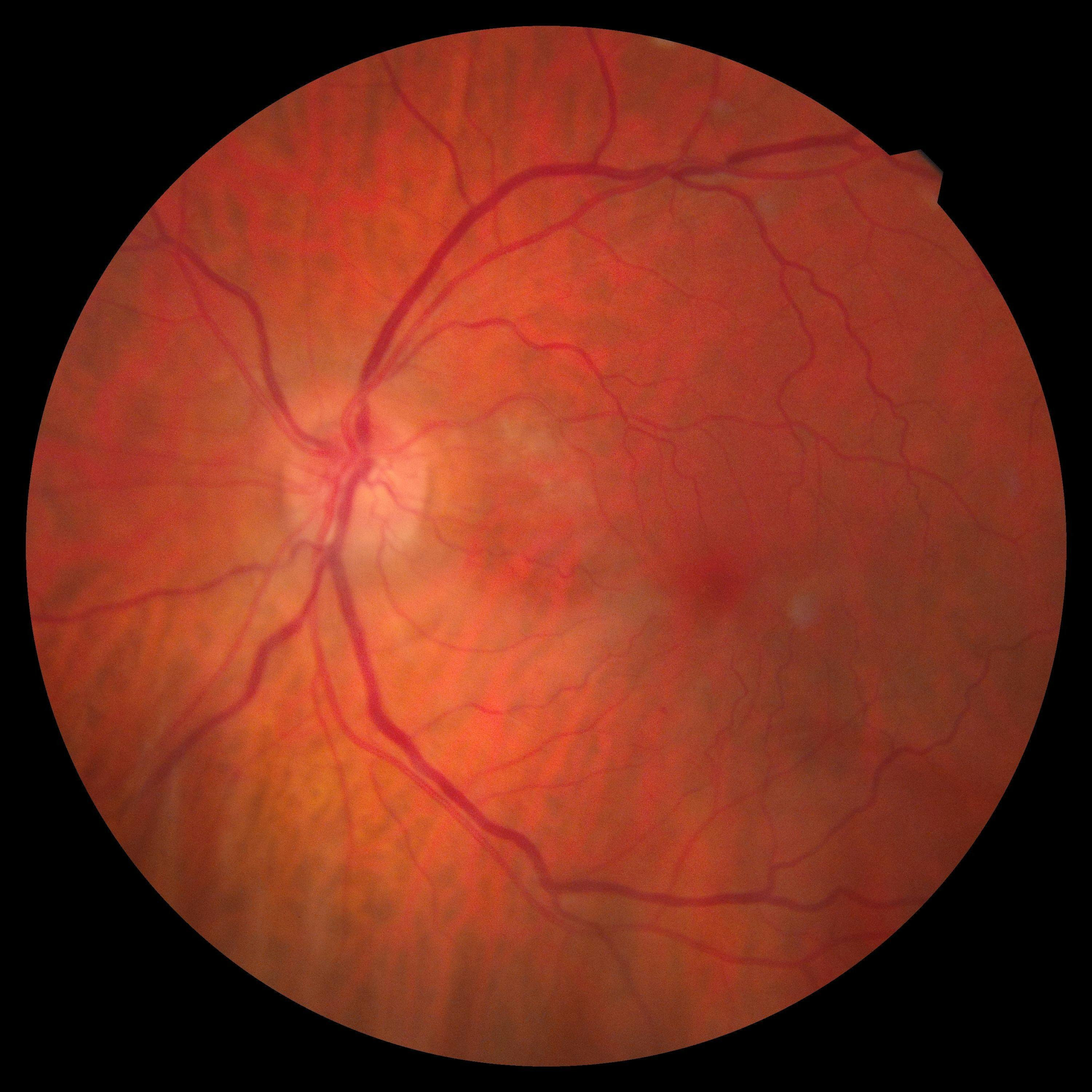 OS fundus initial NAION