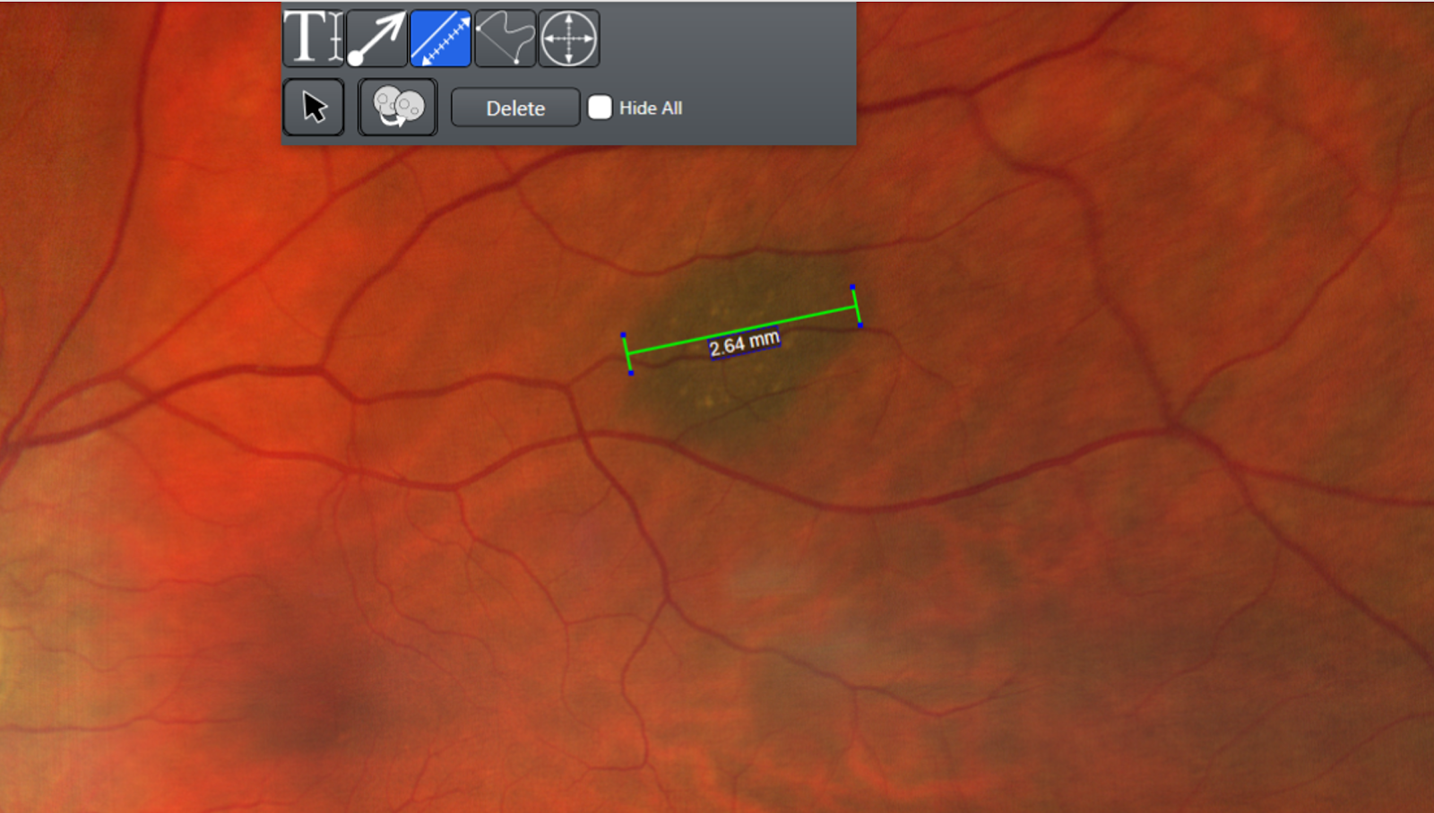 Allow for lesion measurement. Using the caliper function a measurement can be taken to determine the size of a retinal lesion. This patient’s choroidal nevus measured out to be 2.64 mm.