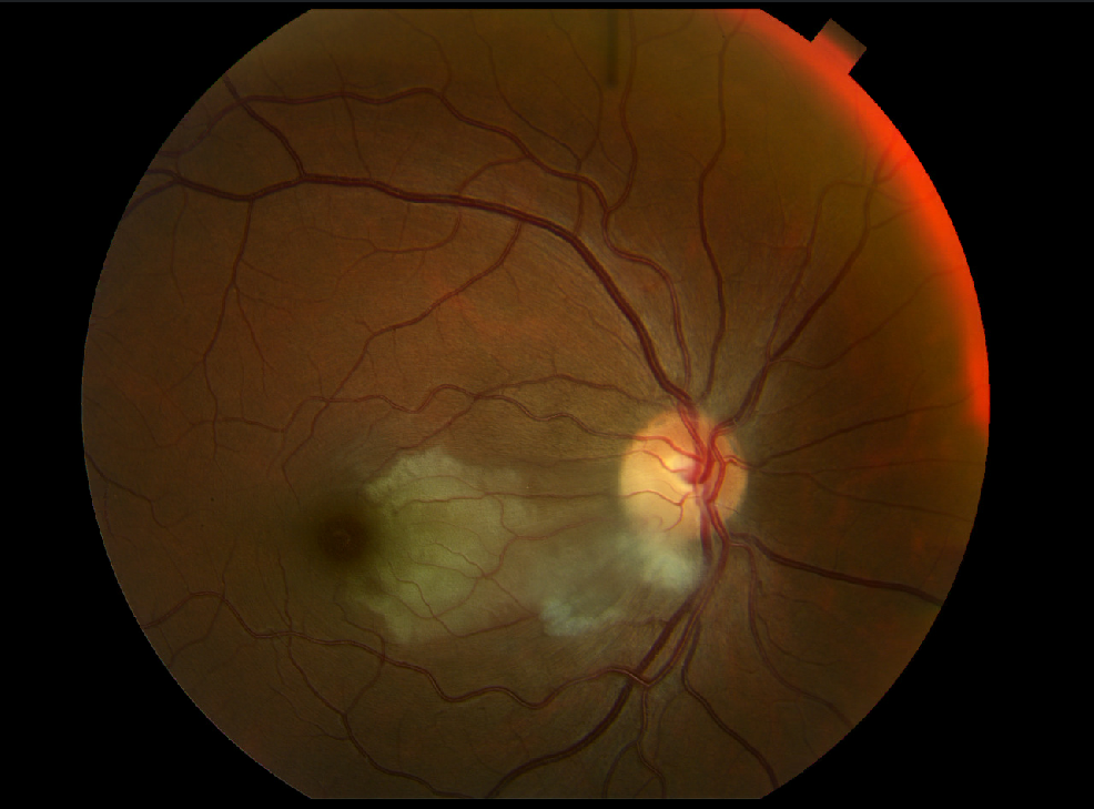 Acute Branch Retinal Artery Occlusion