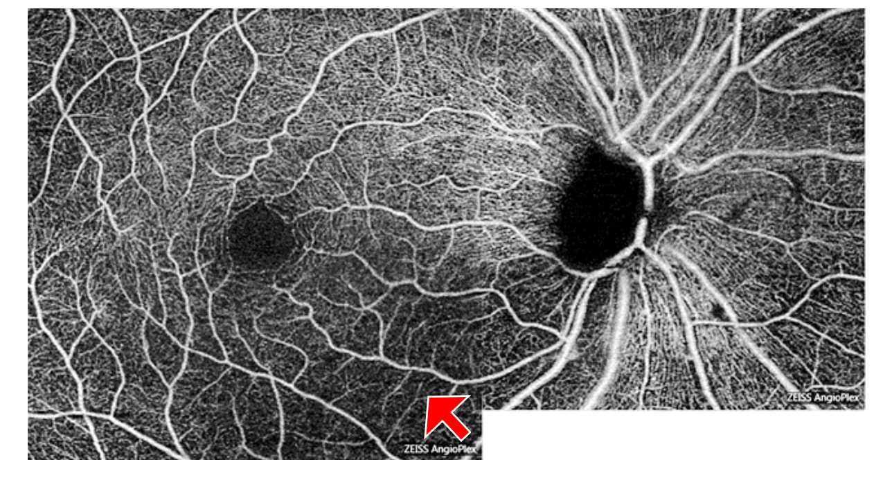  OCTA superficial microvasculature map of a right eye