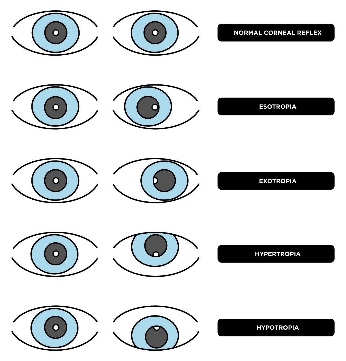 Hirschberg Test Normal The Ultimate Guide to Pediatric Eye Exams for Optometry Students with ...