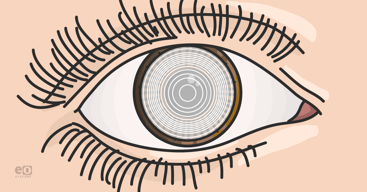 Treating Presbyopia In Cataract Surgery