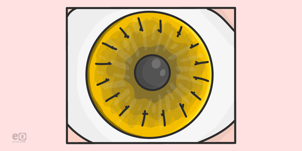 A Guide to Corneal Transplants for Ophthalmology Residents