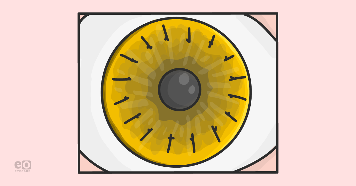 A Guide to Corneal Transplants for Ophthalmology Residents
