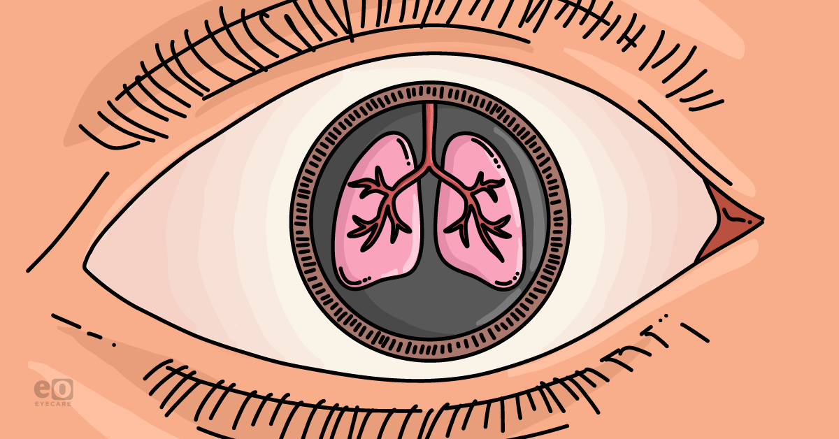 Ocular Manifestations of Cystic Fibrosis