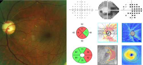 Glaucomatous field loss with RNFL and GCA analysis