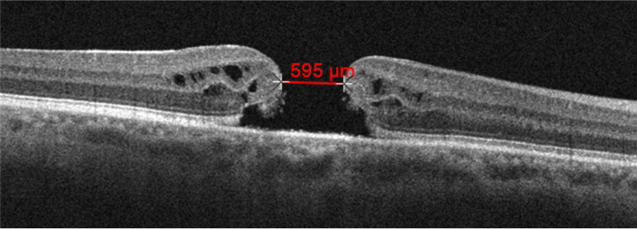 large idiopathic full thickness macular hole