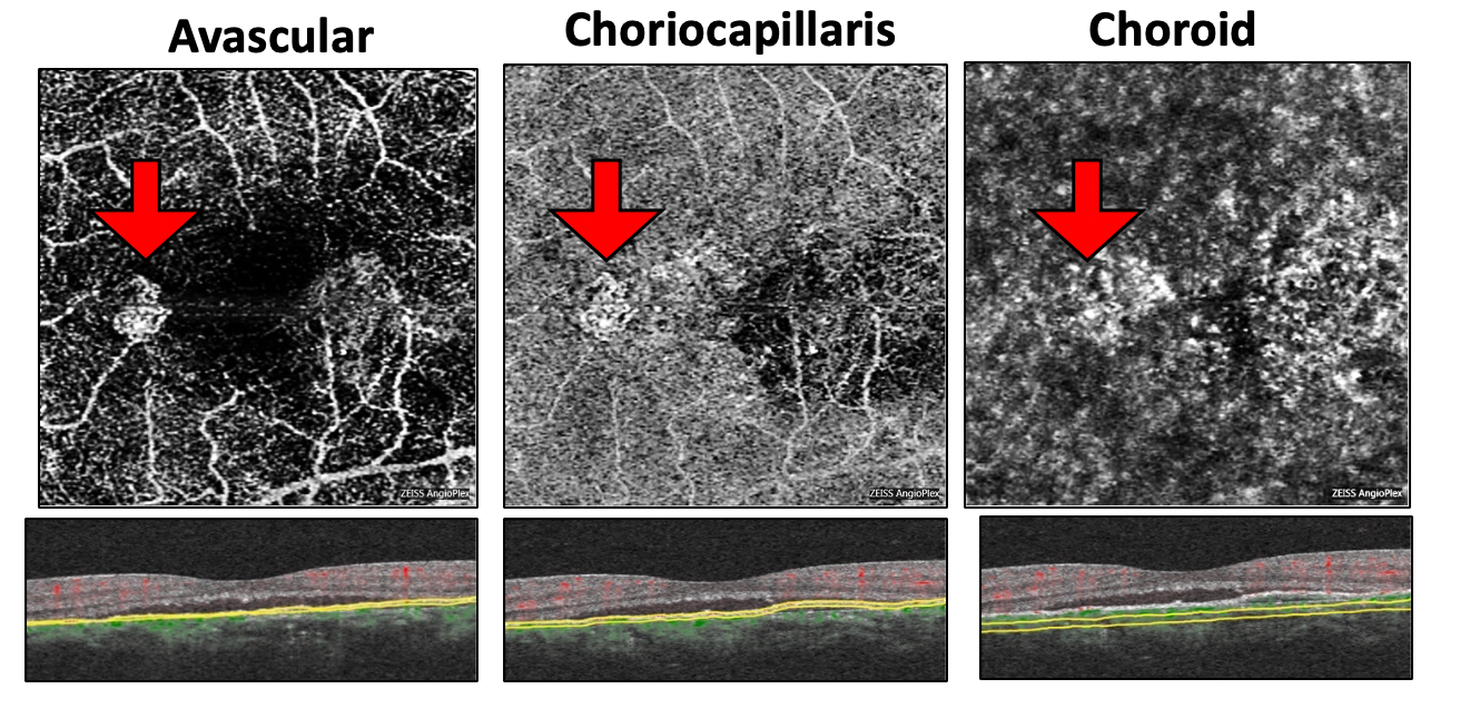Sequential OCTA maps (above) and B scan blood flow overlay (below) showing exudative Type 1 subretinal pigment epithelium choroidal neovascularization (red arrows)  