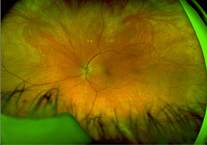 Fields Machine Oct What to Do When Fields and OCT are Inconclusive: A Case Report