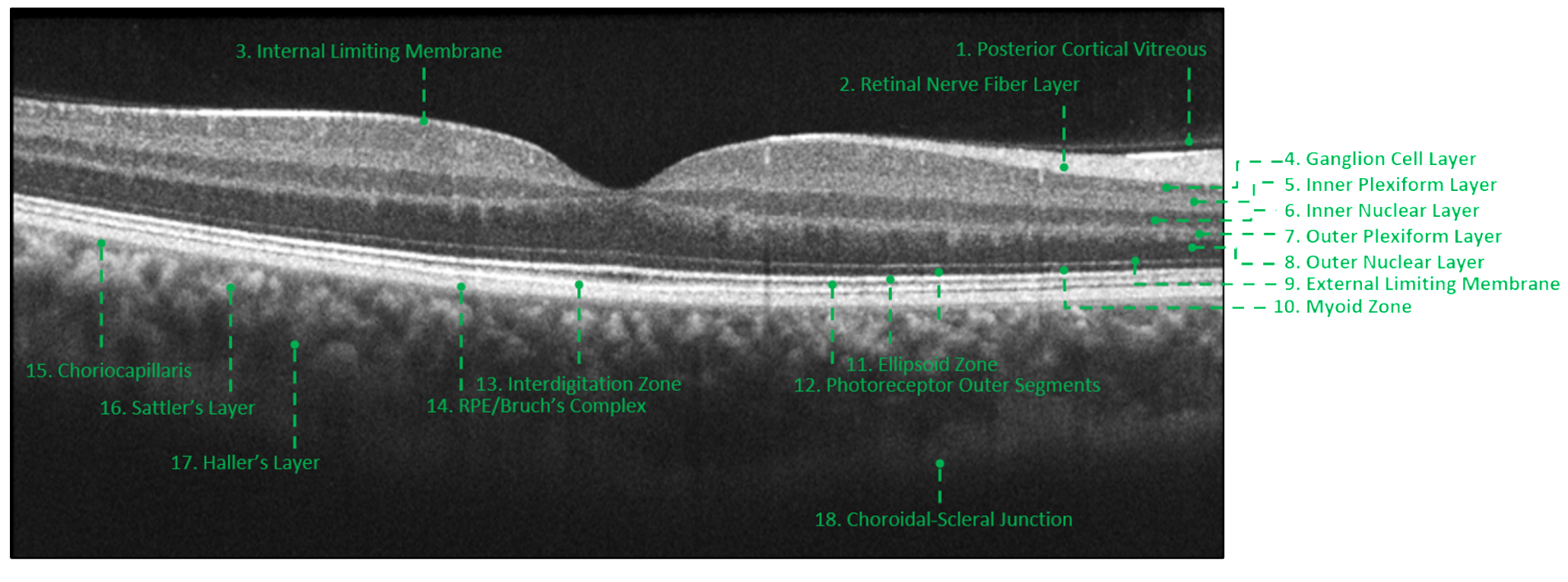 In this healthy macula each layer of the retina can be distinctly identified due to differences in their reflectivities