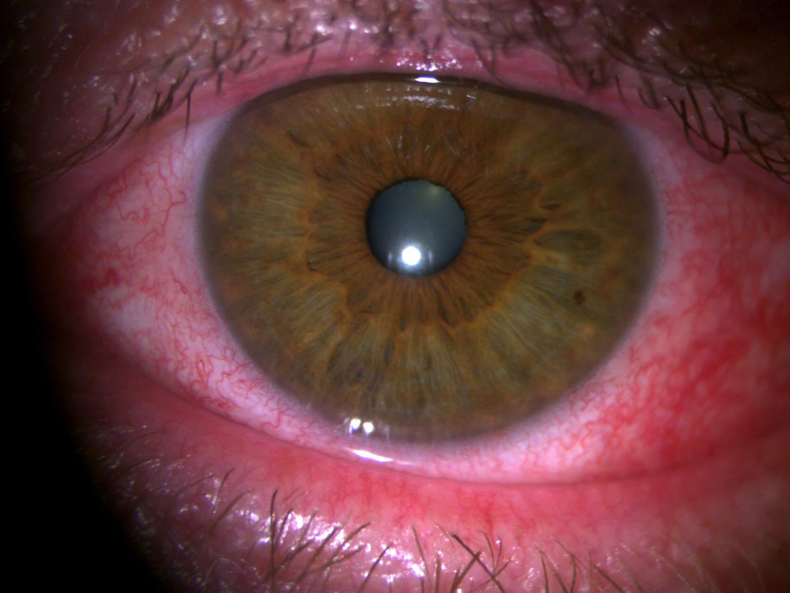 Ocular Rosacea Flare