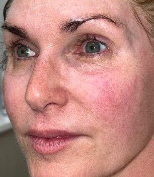 Image of a patient with ocular rosacea before undergoing IPL treatment.