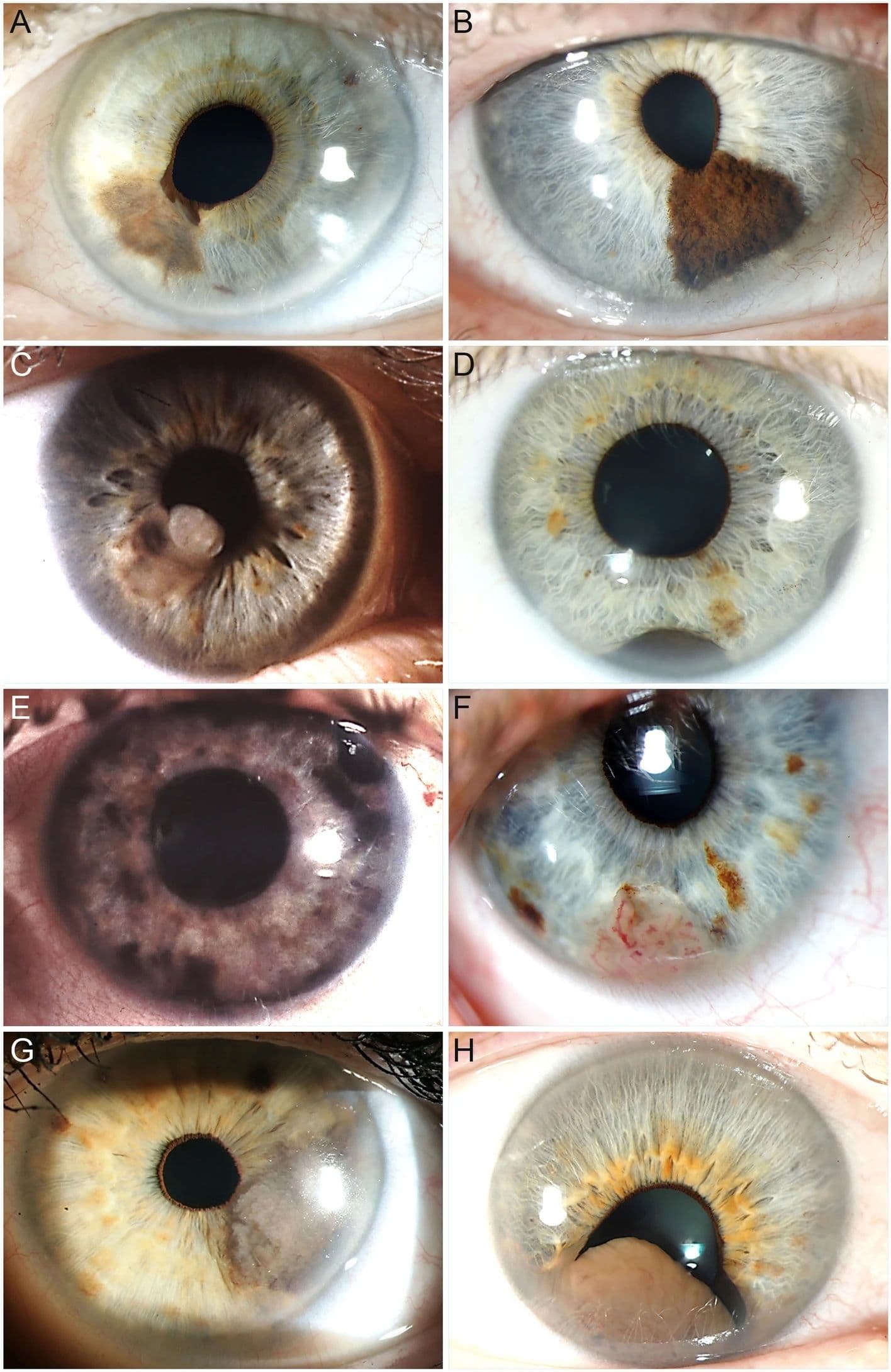 Three Top Ophthalmologists Discuss the Rarest Eye Conditions