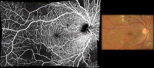 Optic Nerve and Vitreoretinal Interface