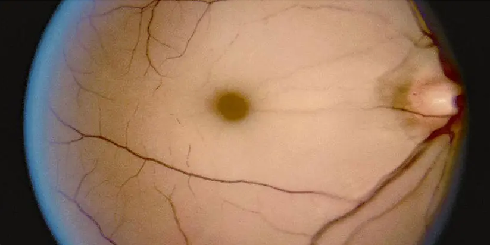Fundus Acute Central Retinal Artery Occlusion