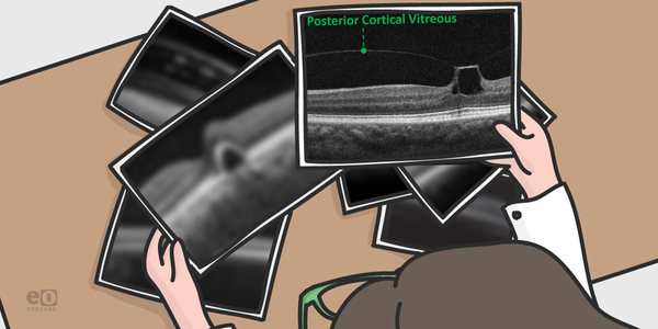 How to Spot Vitreomacular Traction