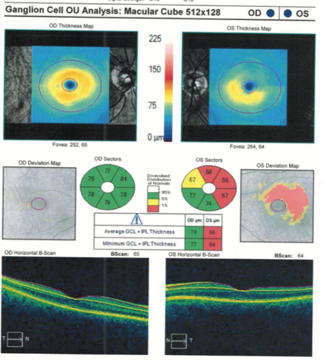 Ganglion cell analysis OU of a patient with hydroxychloroquine (HCQ) retinopathy.