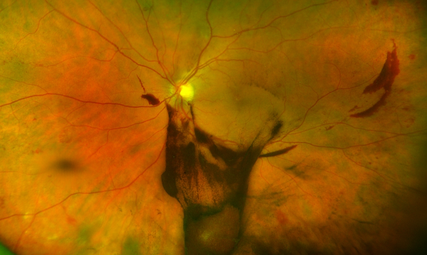 Funduscopic examination in the patient’s left eye (OS) with vitreous hemorrhage, a temporal preretinal heme, intraretinal hemorrhages, and blot hemes.